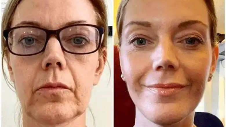 Initiate Refinement through the Best Plastic Surgeon in dubai Using Profhilo