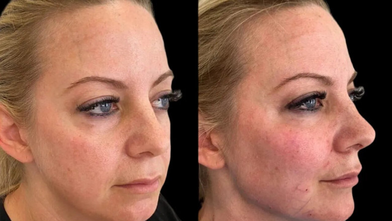 The Best Cheek Fillers Brands Recommended by the Best Plastic Surgeon in Dubai