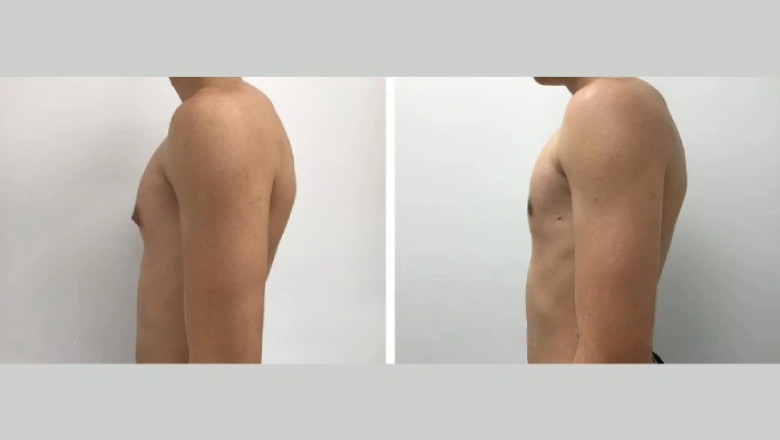 What Is the Recovery Time for Gynecomastia Surgery in Dubai?