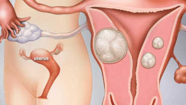 Fibroid Doctor near me