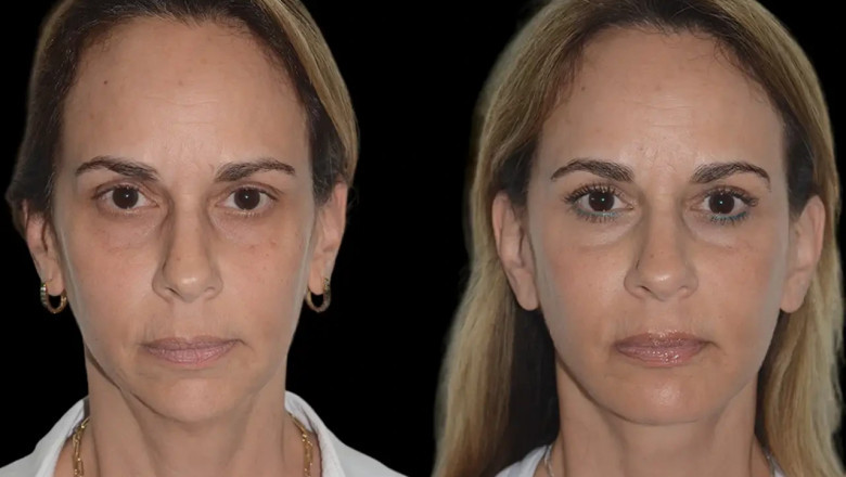 Best Aesthetic Clinics in dubai for Chin Fillers: Perfect Your Chin and Jawline