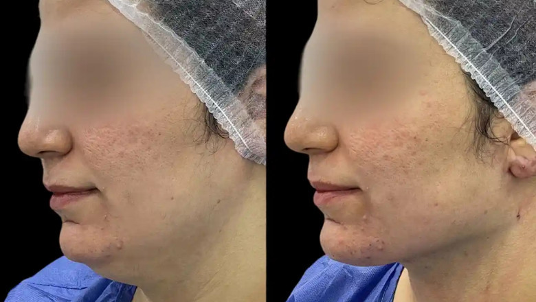 Best Aesthetic Clinics in dubai for Chin Fillers: Perfect Your Chin and Jawline