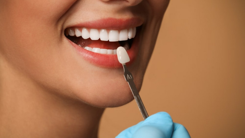 Top Dentists for Dental Veneers in Keller, TX: What to Expect at Keller Family Dental