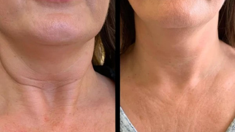 Why the Best Aesthetic Clinics in Dubai Recommend Profhilo for Anti-Aging