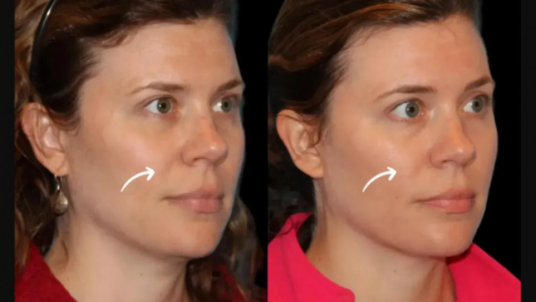 Dispelling Myths – Will Sculptra Fillers in Dubai Replace Cosmetic Surgery?