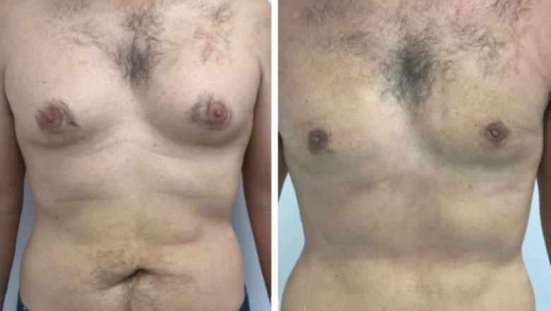 How to Choose the Best Gynecomastia Surgeons in dubai for the Best Results