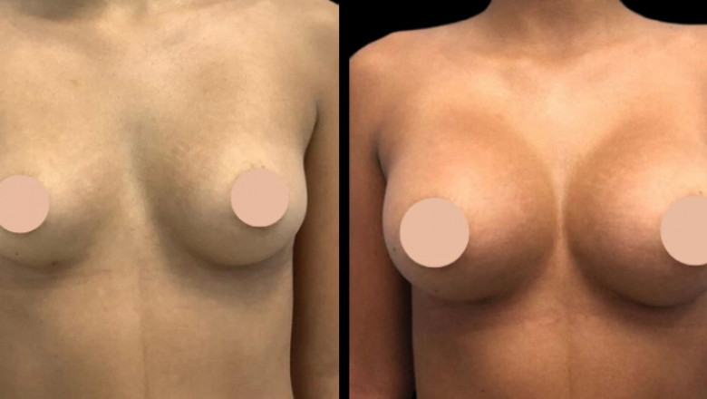 Inside Dubai’s Clinics: Best Breast Augmentation Surgeons Revealed
