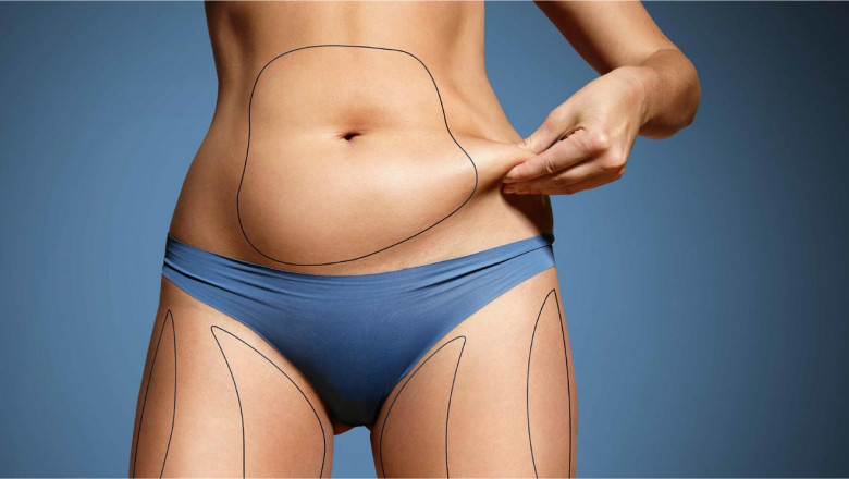 Abdominoplasty in Dubai: The Ideal Candidates for Abdominoplasty Surgery