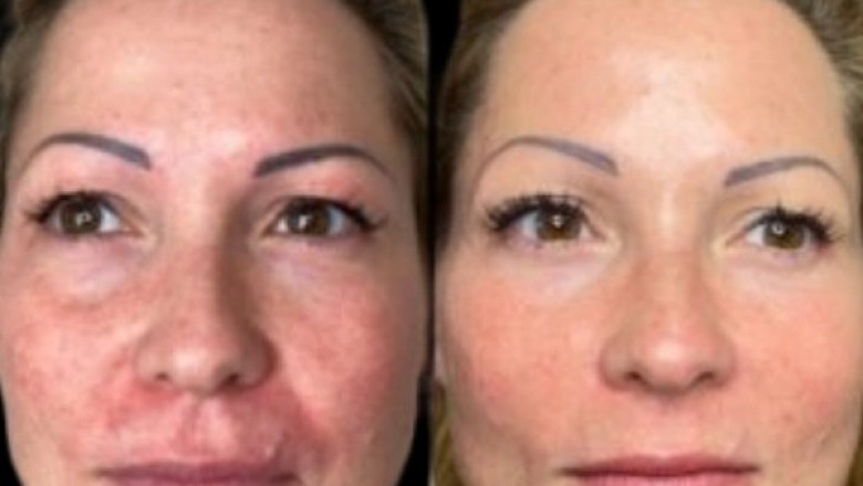 Choose Profhilo with Best Plastic Surgeons in dubai Today