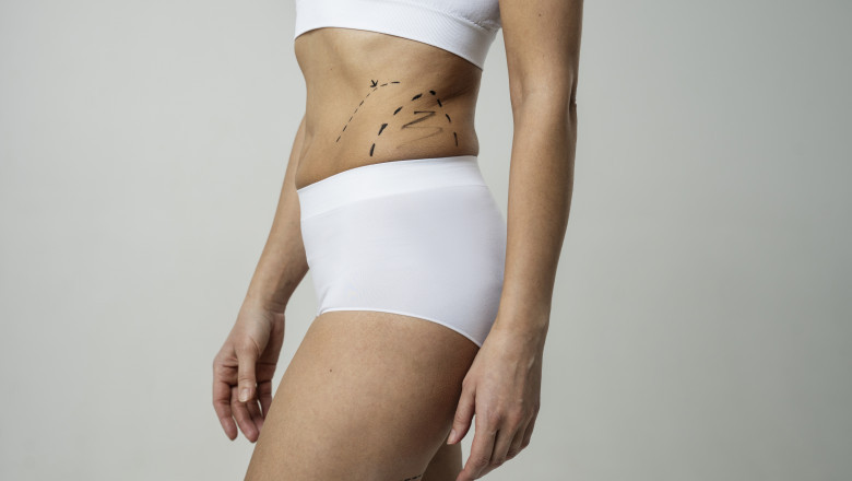 Liposuction and Lifestyle Guidance from Best Doctors in Dubai