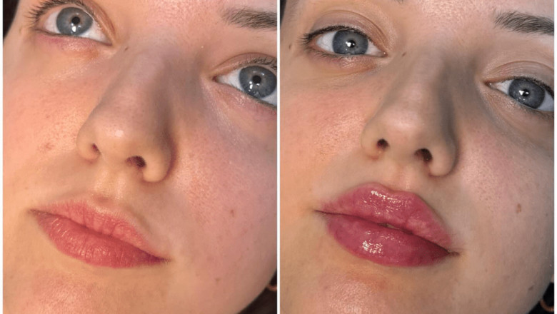 How Juvederm Helps in Restoring Skin Volume and Elasticity: Tips from the Best Plastic Surgeon in Dubai