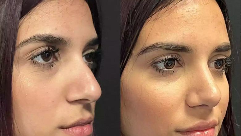 How Septoplasty in Dubai Can Improve Your Everyday Life