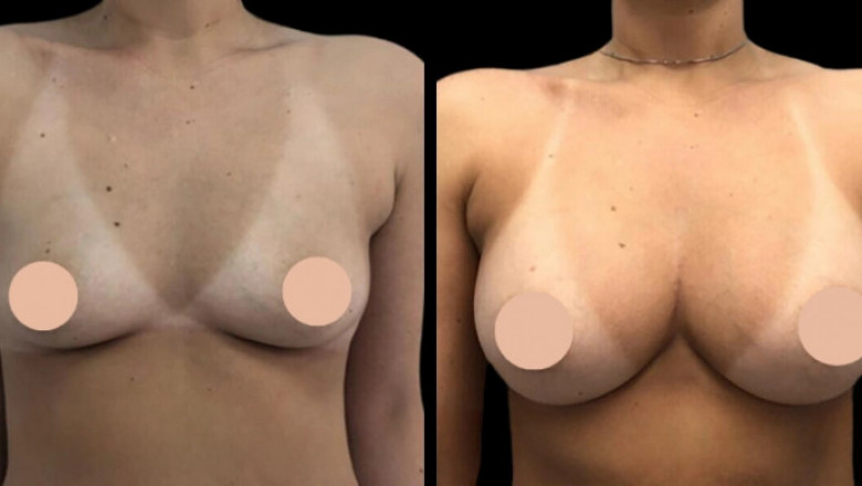 Natural-Looking Results: Breast Augmentation in Dubai Explained