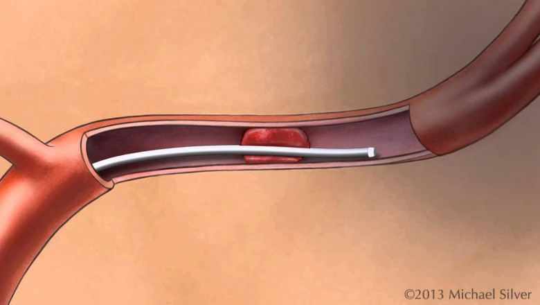 Blood Clot Retrieval Devices Market Set for Considerable Growth Due to Advancements in Mechanical Thrombectomy Technologies