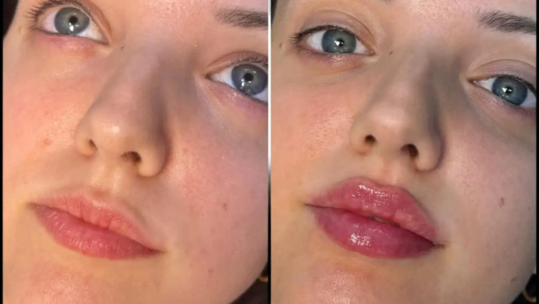 Fillers Treatment in Dubai for a More Defined Jawline