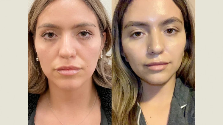 How Thread Lift Treatment in Dubai Can Boost Your Confidence and Self-Esteem