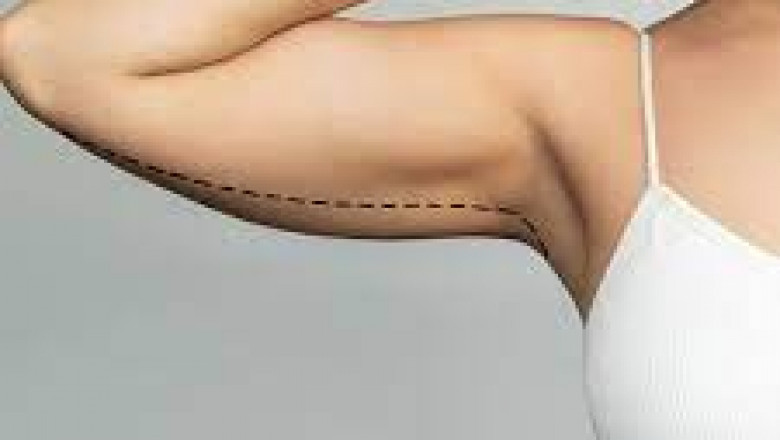 Arm Lift in Jeddah: Tighten and Tone Sagging Arms for a Sleeker Silhouette