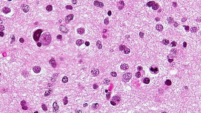 Astrocytoma Drug Market: Size, Trends, and Growth Forecast