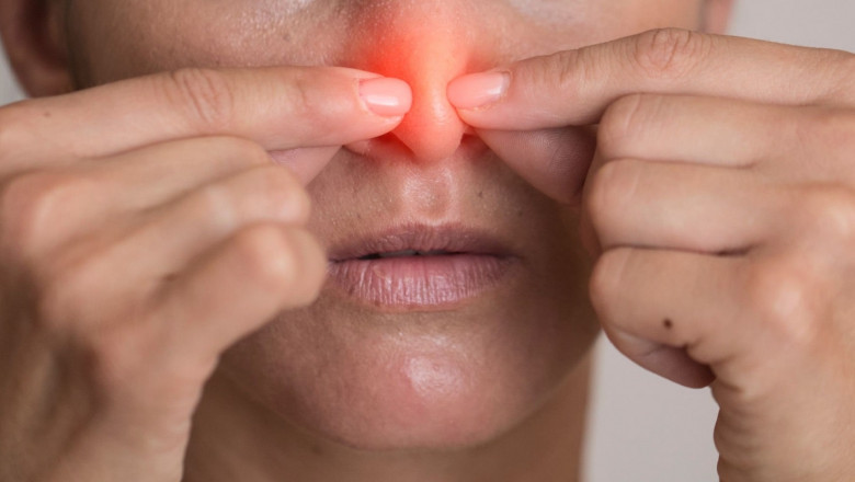 Nasal Polyps Treatment Market to Surge with Biologic Therapy Advances