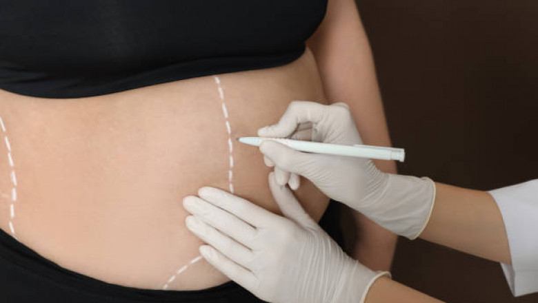 خبراء التجميل لجراحة التثدي بالرياض