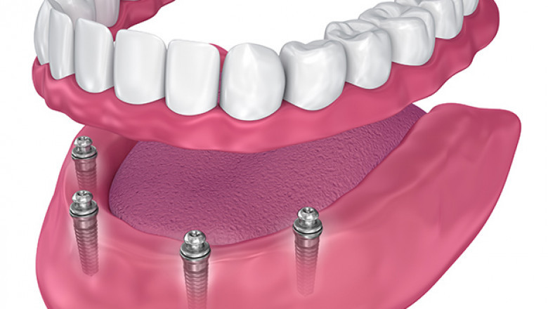 Local Dental Implants: A Permanent Solution for Missing Teeth