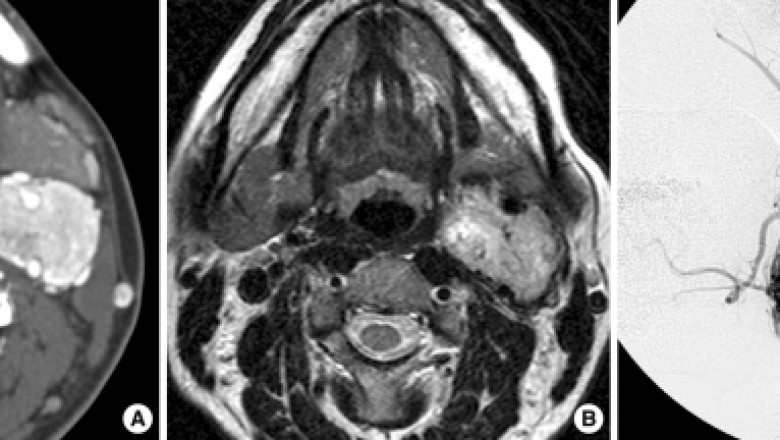 Paraganglioma Market Growth Trends and Investment Outlook