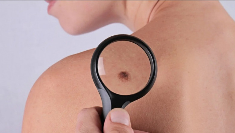 Melanoma Scanner Market: Revolutionizing Skin Cancer Detection