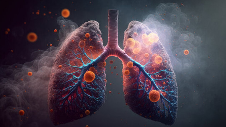 Non-Small Cell Lung Cancer Market Size, Trends, and Growth Opportunities 2025-2032