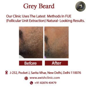 Best Grey Beard Treatment | White Beard Solution in Delhi, India - AWISH CLINIC