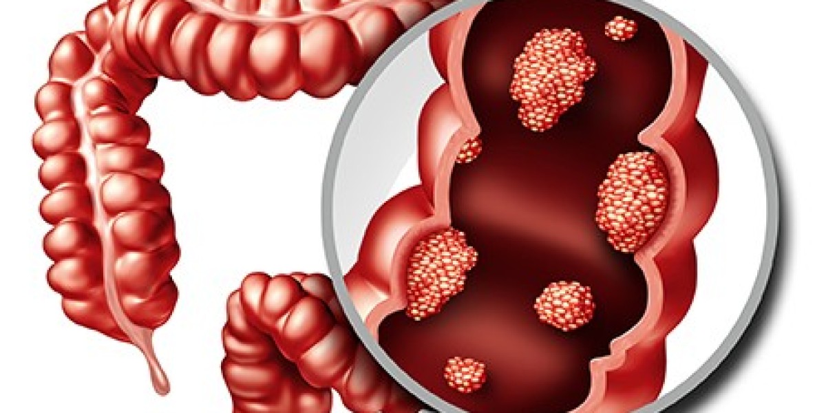 Global Colorectal Cancer Therapeutics Market Size, Share, Growth, Reports To 2033