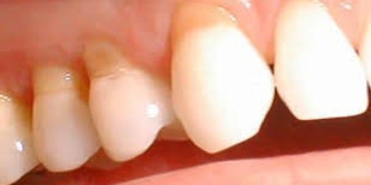 Exploring Dental Glass Ionomer Cements (GIC): Applications and Benefits in Modern Dentistry