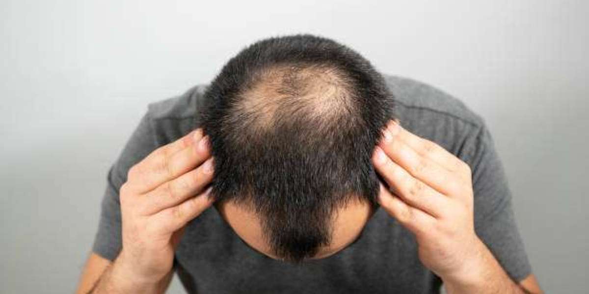 Top Hair Transplant Clinics and Hair Laser Treatments in Karachi: Your Ultimate Guide