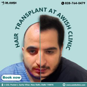 FUE Hair Transplant Treatment | Natural Hair Restoration - AWISH CLINIC