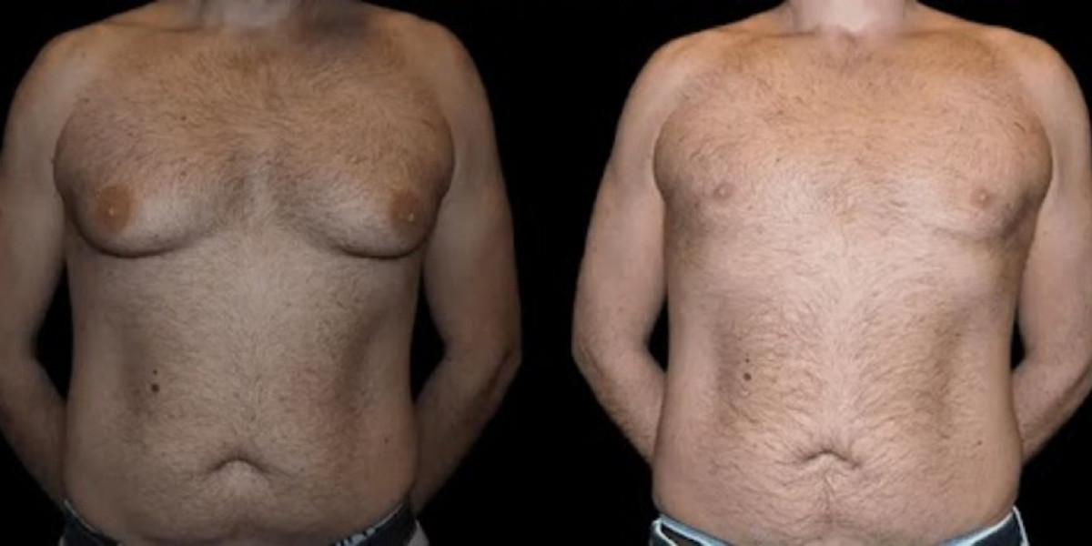 A Guide to Finding Affordable Gynecomastia Surgery Options in Dubai