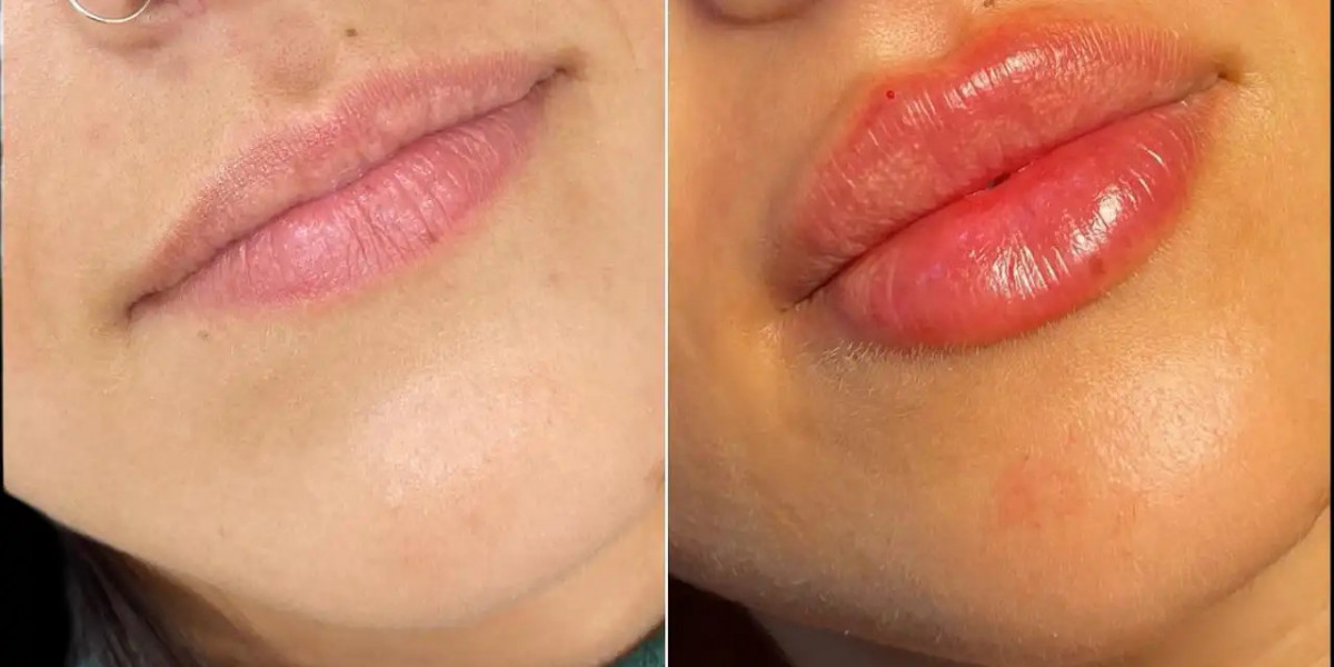 Long-Lasting Results with the Best Juvederm Fillers Dermatologists in Dubai