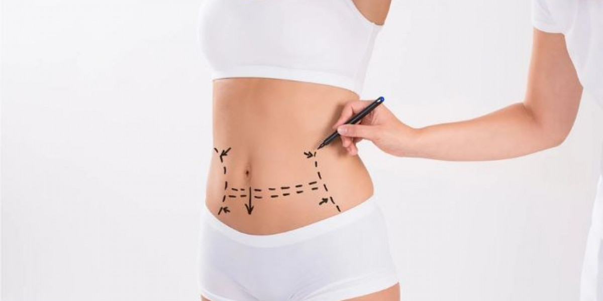 Transform Your Look: Liposuction Abdomen 360 in Maryland at Aesthetic LAVC