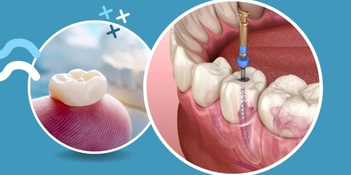 Root Canals - What Are They?