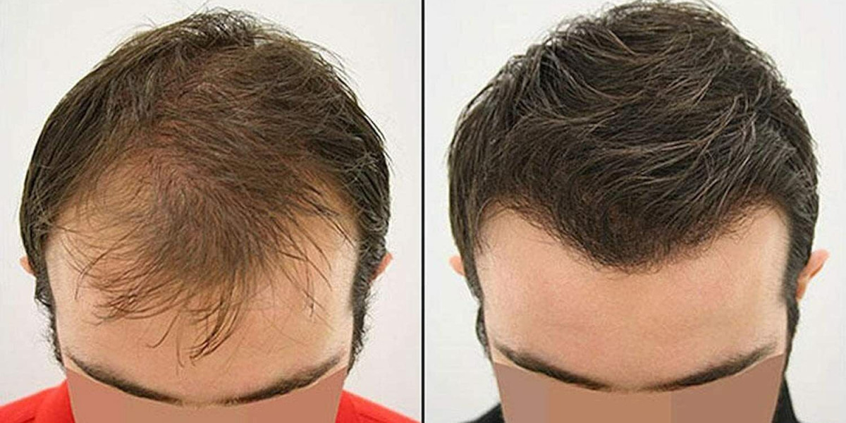 Top-Rated Hair Transplant Clinics in Dubai