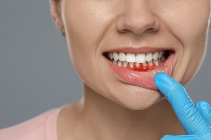 How Can You Effectively Treat Periodontal Disease? – @cosmeticsmile1 on Tumblr