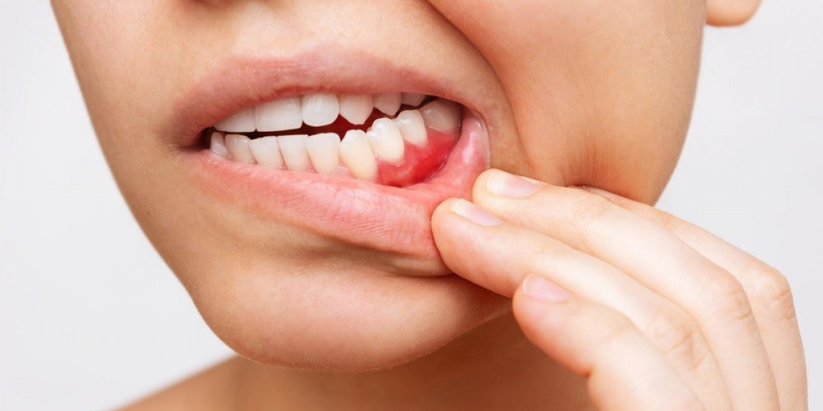 Understanding Periodontal Disease and Gingivitis: Symptoms, Treatment, and Prevention