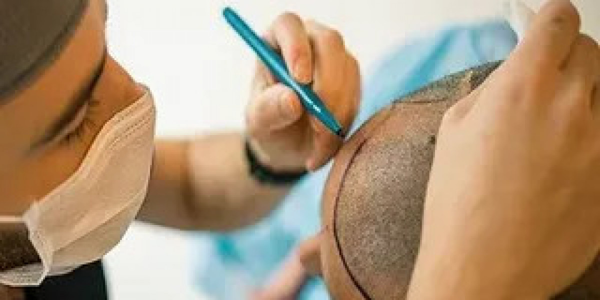 Understanding Hair Transplant Density: What to Expect in Islamabad
