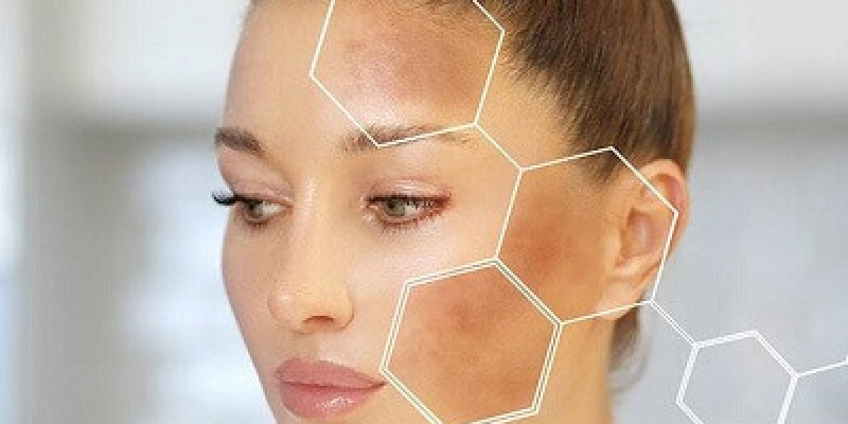 What Causes Melasma and How to Prevent It in Islamabad’s Climate?