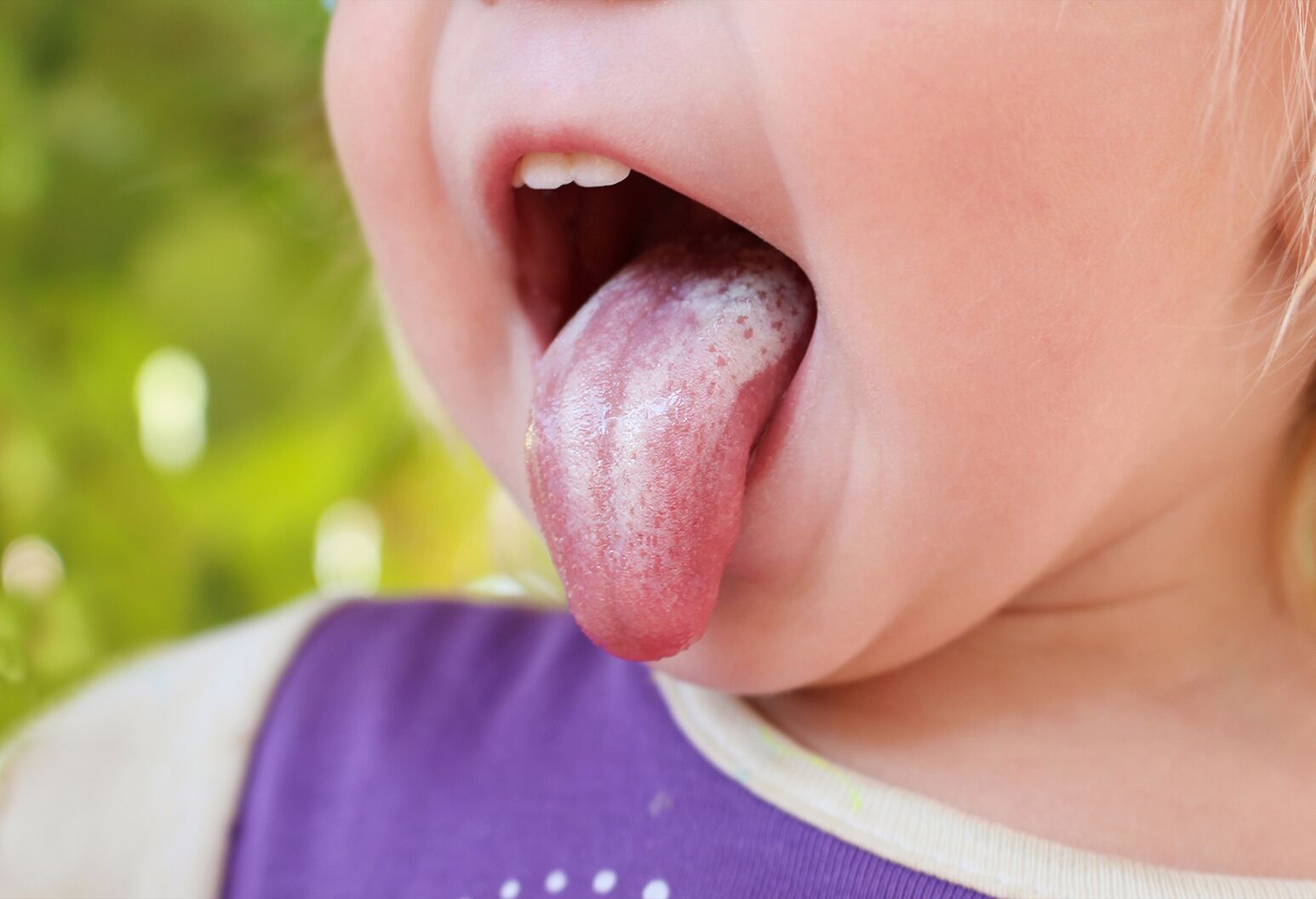 Fungal Mouth Infection: Extensive Guide to Exposing and Treating
