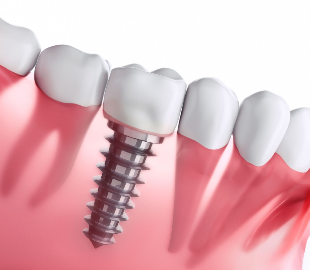 Dental Implants in Dubai | Trusted Implant Specialists