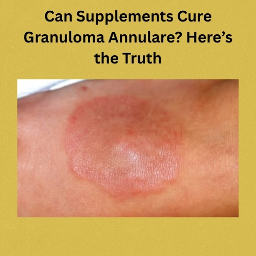 Can Supplements Cure Granuloma Annulare? Here’s the Truth – Herbal Care Products