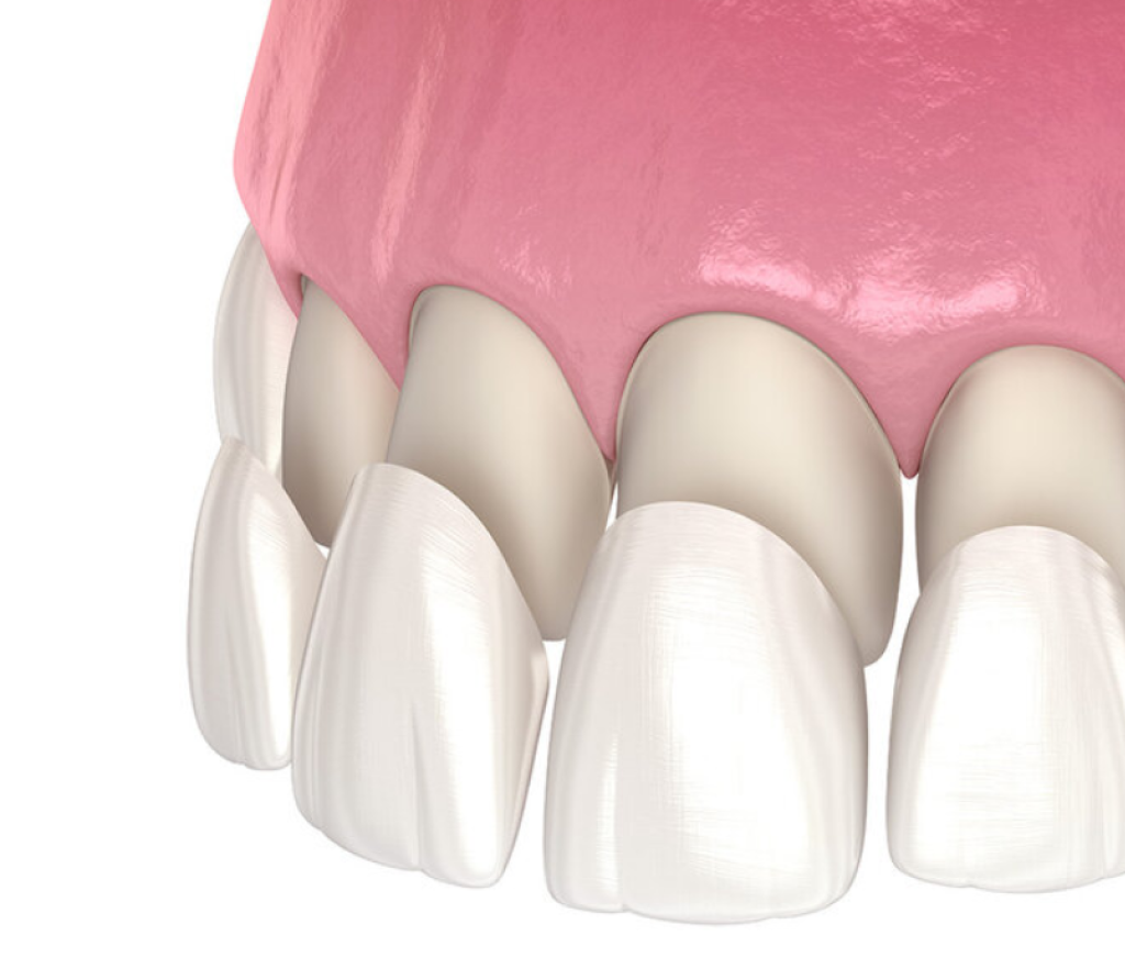 Teeth Veneers in Dubai | Premium Dental Veneers in Dubai