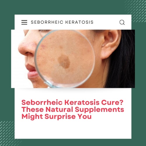 Seborrheic Keratosis Cure? These Natural Supplements Might Surprise You