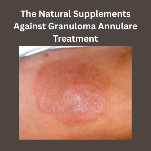 The Natural Supplements Against Granuloma Annulare Treatment - Blogingers