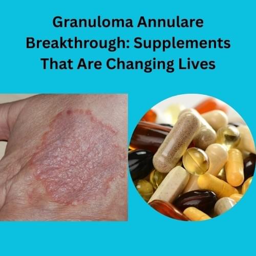 Granuloma Annulare Breakthrough: Supplements That Are C...