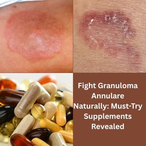 Fight Granuloma Annulare Naturally: Must-Try Supplements Revealed - Herbal Care Products Blog